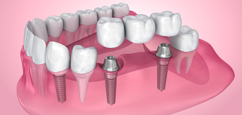 You are currently viewing Understanding Dental Implants