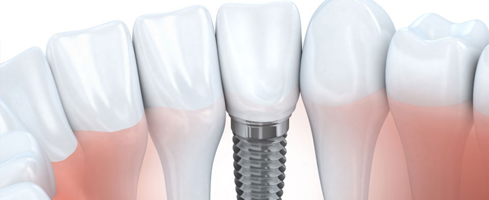 You are currently viewing How do dental implants help with bone loss and gum diseases?