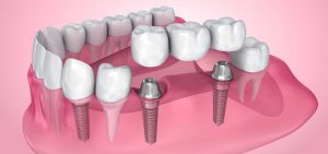 Read more about the article Understanding The Process Of Dental Implants