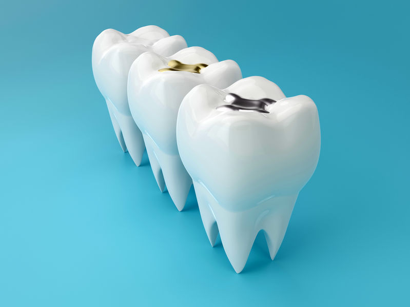 Read more about the article How To Choose The Best Dental Fillings