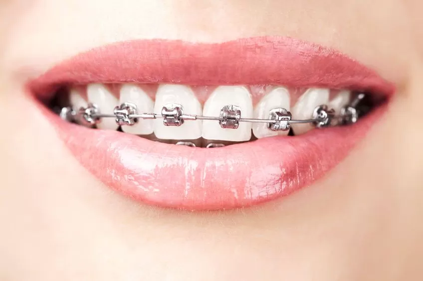 You are currently viewing Can adults wear braces?