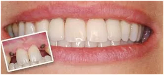 dental implants edgecliff