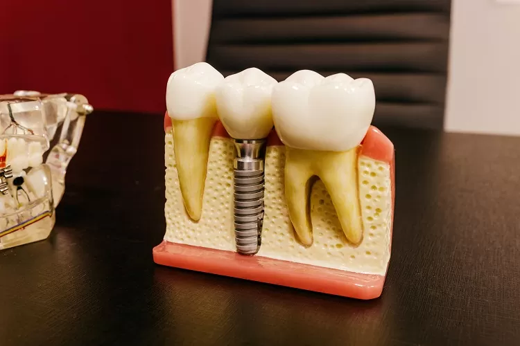 You are currently viewing Dental implants: Can it fall off and what to do if it does